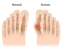 Non-Surgical Treatment of Bunions