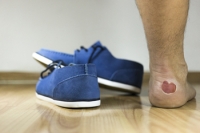 Causes and Symptoms of Foot Blisters