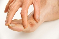 Permanent Removal May Be Necessary for Bunions