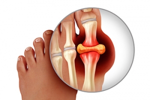 Gout Attacks Are Painful