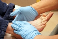 Recognizing Diabetic Symptoms in the Feet